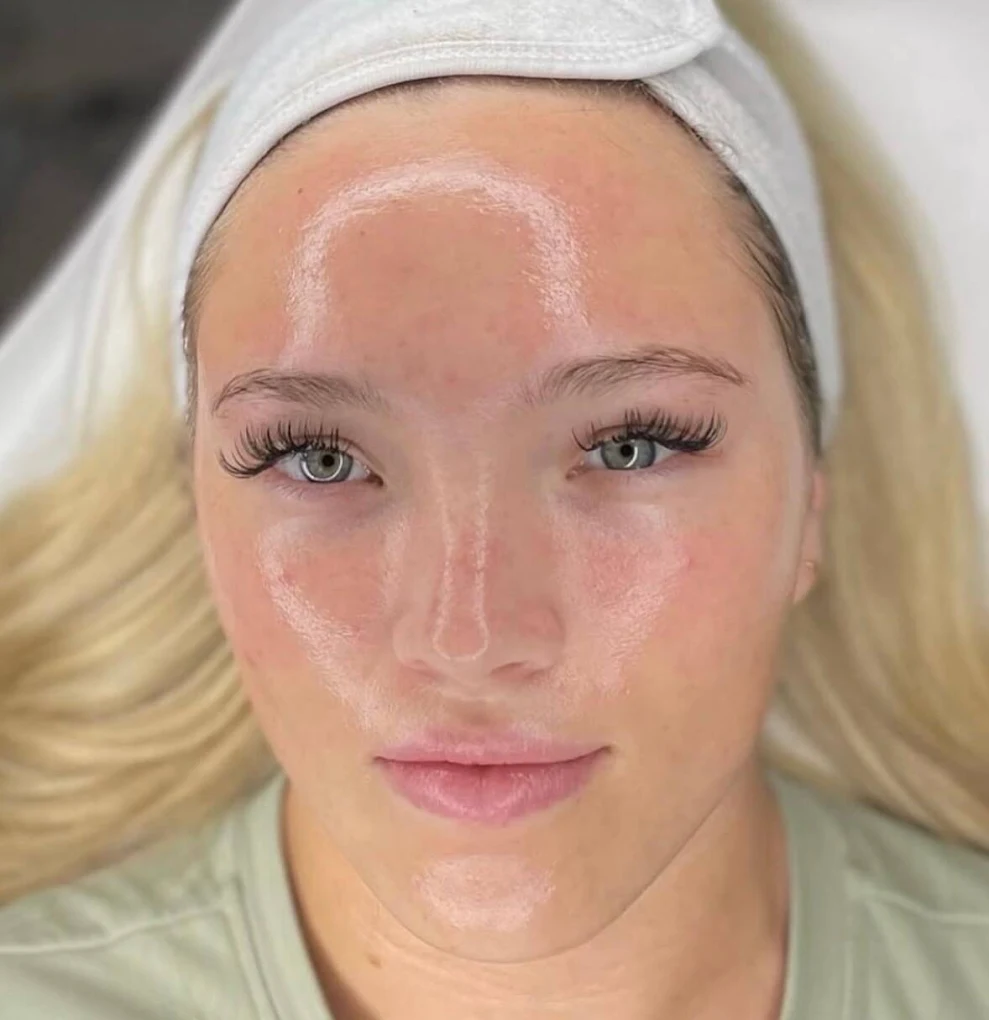 HydraFacial result