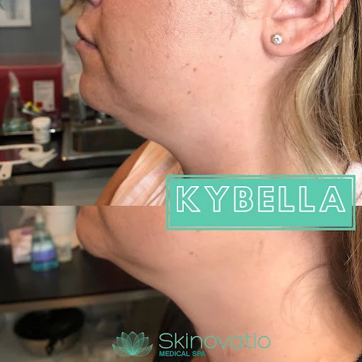 Kybella result