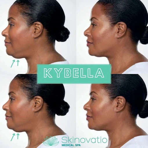 Kybella result