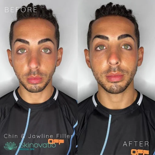 Chin & Jawline Filler result