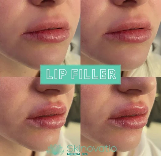 Lip Filler result