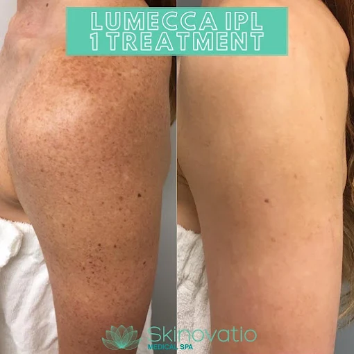Lumecca IPL result
