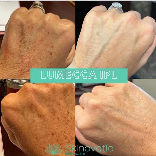 Lumecca IPL result