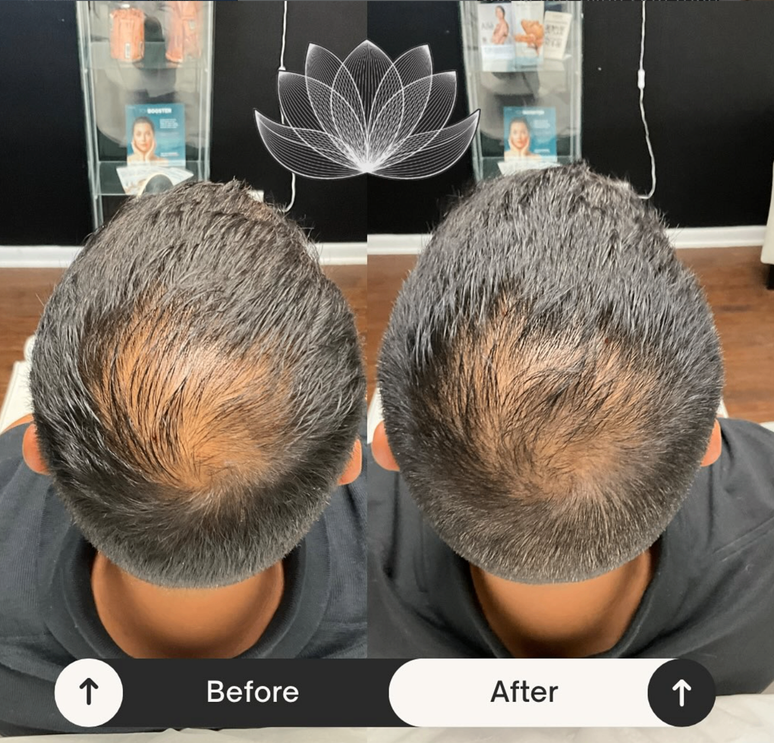 PRP Hair Restoration result