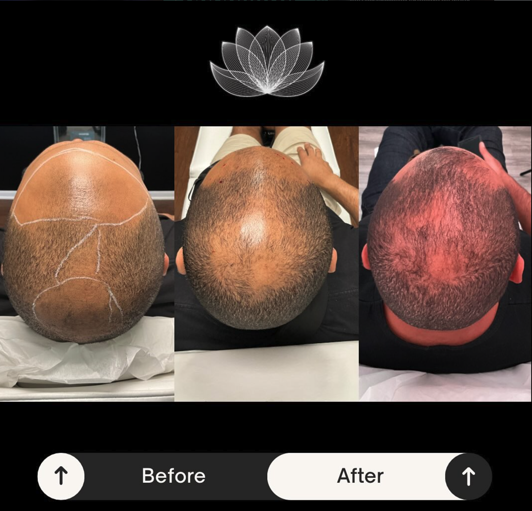 PRP Hair Restoration result
