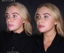 Lip Filler result